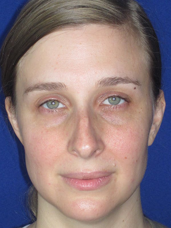 Rhinoplasty Before & After Gallery - Patient 165413237 - Image 3