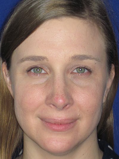 Rhinoplasty Before & After Gallery - Patient 165413237 - Image 4