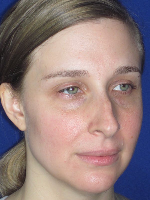 Rhinoplasty Before & After Gallery - Patient 165413237 - Image 5