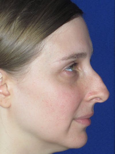 Rhinoplasty Before & After Gallery - Patient 165413237 - Image 1
