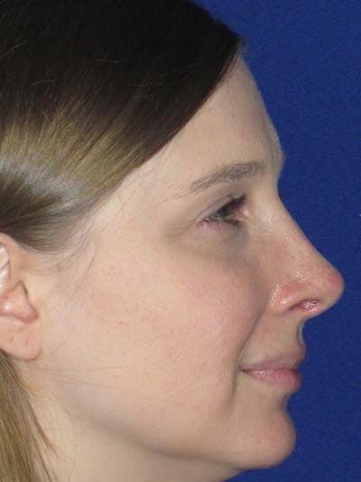 Rhinoplasty Before & After Gallery - Patient 165413237 - Image 2