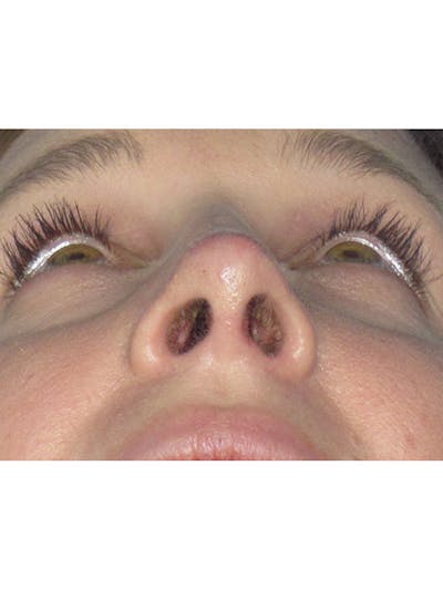 Rhinoplasty Before & After Gallery - Patient 165413237 - Image 8