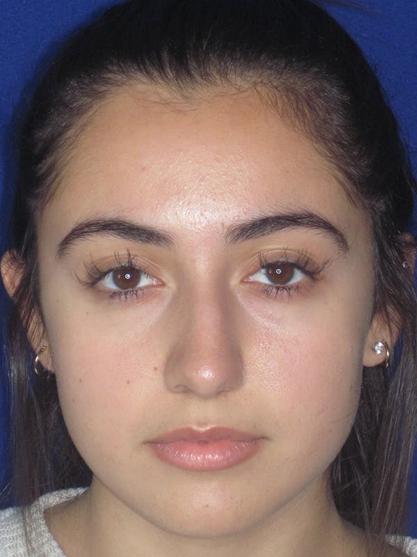 Rhinoplasty Before & After Gallery - Patient 165413239 - Image 7