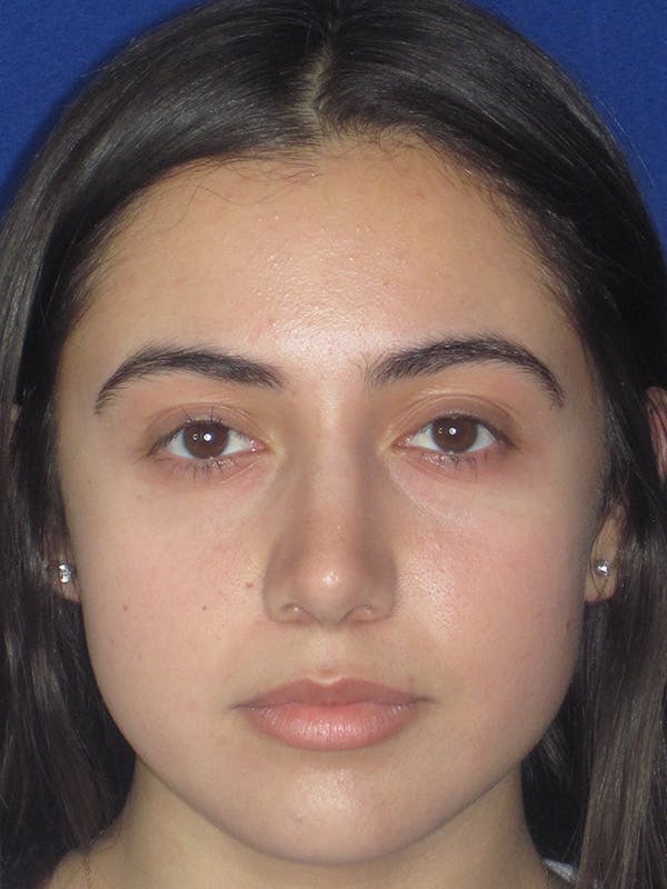 Rhinoplasty Before & After Gallery - Patient 165413239 - Image 8