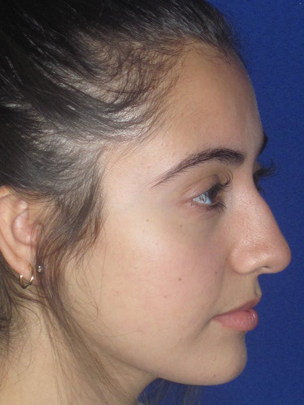Rhinoplasty Before & After Gallery - Patient 165413239 - Image 1