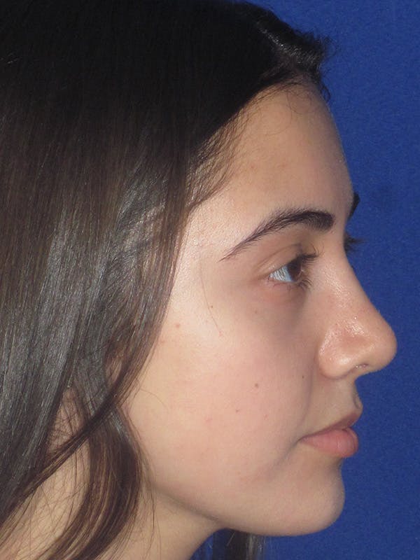 Rhinoplasty Before & After Gallery - Patient 165413239 - Image 2