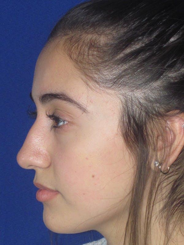 Rhinoplasty Before & After Gallery - Patient 165413239 - Image 3