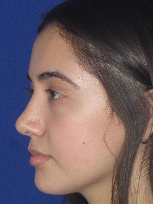 Rhinoplasty Before & After Gallery - Patient 165413239 - Image 4