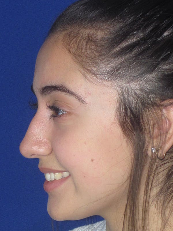 Rhinoplasty Before & After Gallery - Patient 165413239 - Image 5