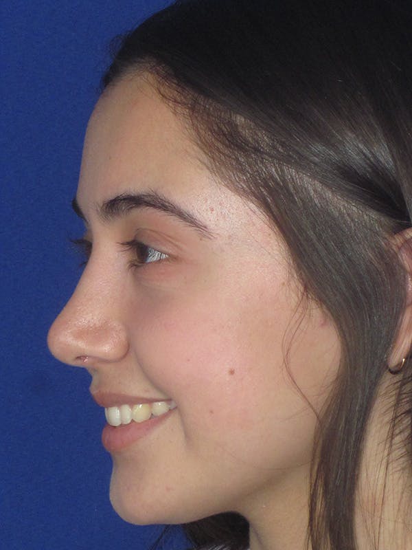Rhinoplasty Before & After Gallery - Patient 165413239 - Image 6