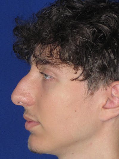 Rhinoplasty Before & After Gallery - Patient 165413941 - Image 1