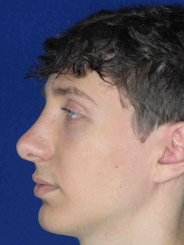 Rhinoplasty Before & After Gallery - Patient 165413941 - Image 2