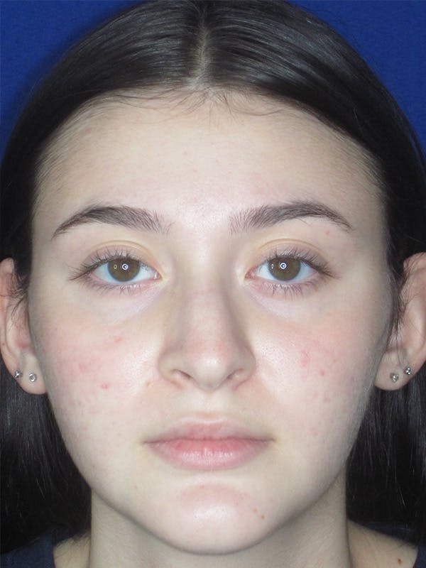 Rhinoplasty Before & After Gallery - Patient 165413942 - Image 1