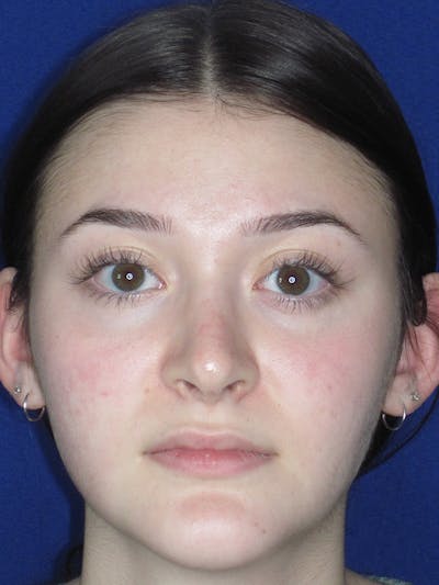 Rhinoplasty Before & After Gallery - Patient 165413942 - Image 2