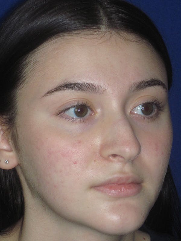 Rhinoplasty Before & After Gallery - Patient 165413942 - Image 3