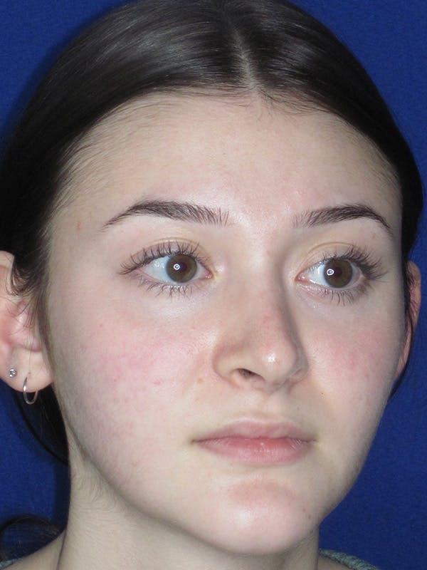 Rhinoplasty Before & After Gallery - Patient 165413942 - Image 4