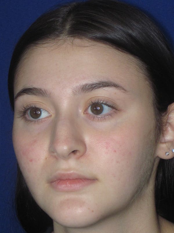 Rhinoplasty Before & After Gallery - Patient 165413942 - Image 5