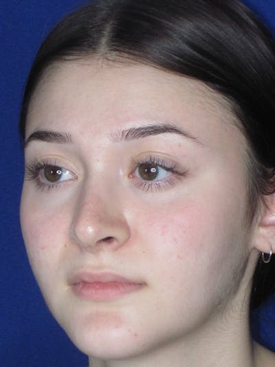 Rhinoplasty Before & After Gallery - Patient 165413942 - Image 6