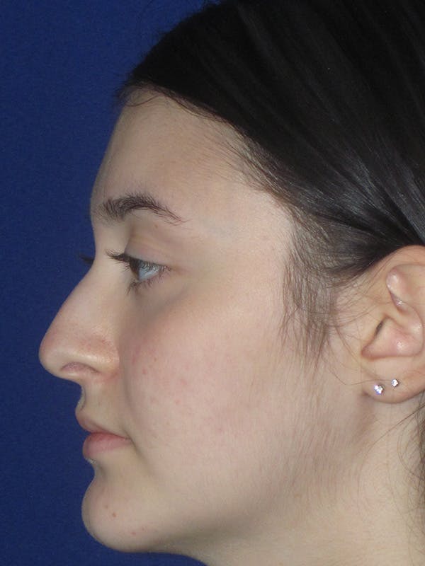 Rhinoplasty Before & After Gallery - Patient 165413942 - Image 7