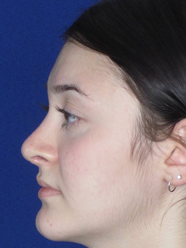 Rhinoplasty Before & After Gallery - Patient 165413942 - Image 8
