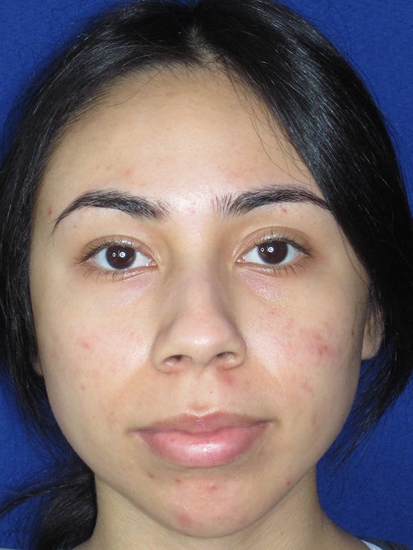 Rhinoplasty Before & After Gallery - Patient 165416658 - Image 1
