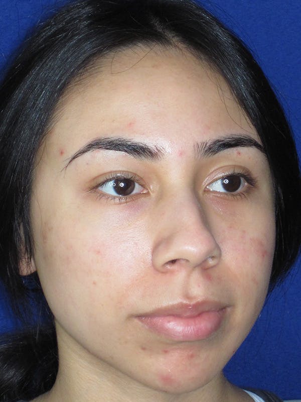 Rhinoplasty Before & After Gallery - Patient 165416658 - Image 3