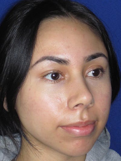 Rhinoplasty Before & After Gallery - Patient 165416658 - Image 4