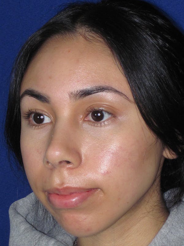 Rhinoplasty Before & After Gallery - Patient 165416658 - Image 6