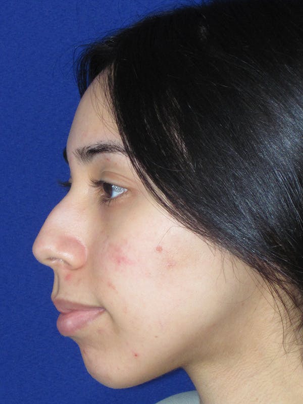Rhinoplasty Before & After Gallery - Patient 165416658 - Image 9