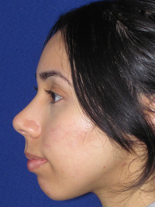 Rhinoplasty Before & After Gallery - Patient 165416658 - Image 10