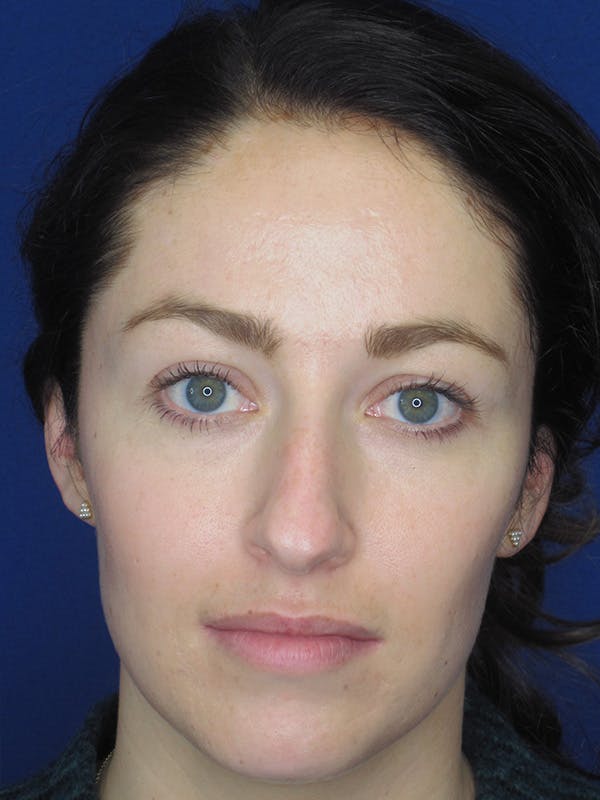 Rhinoplasty Before & After Gallery - Patient 165416659 - Image 5