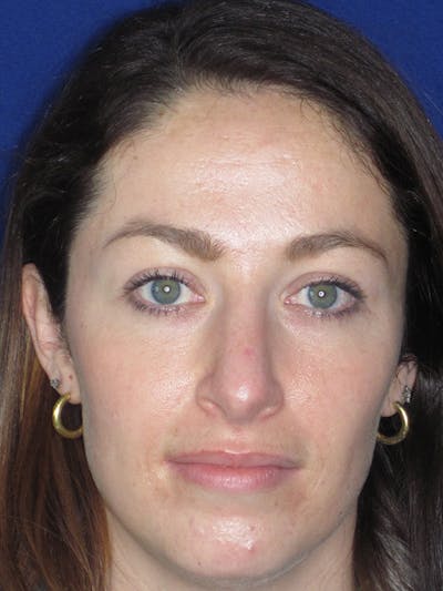 Rhinoplasty Before & After Gallery - Patient 165416659 - Image 6