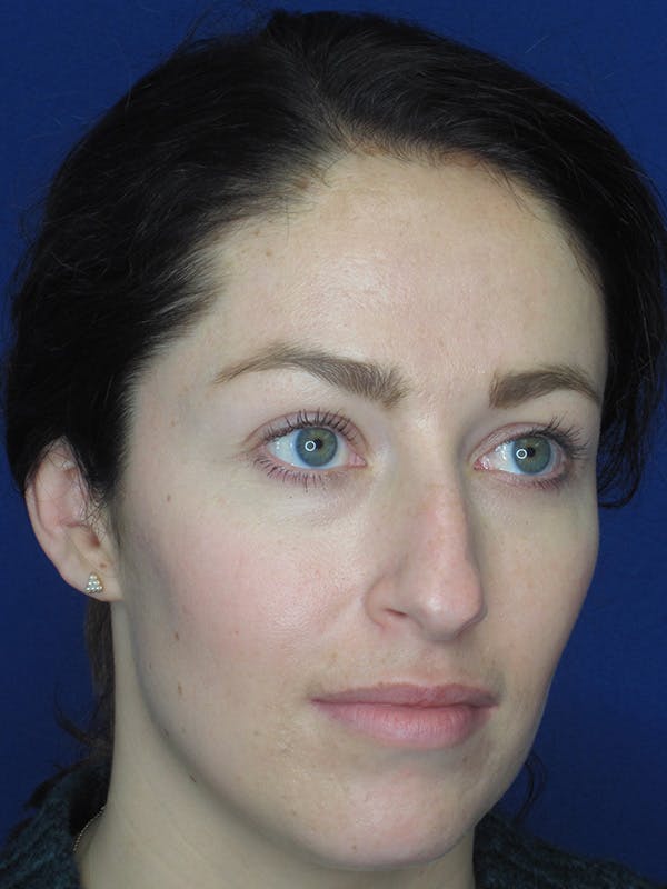 Rhinoplasty Before & After Gallery - Patient 165416659 - Image 3