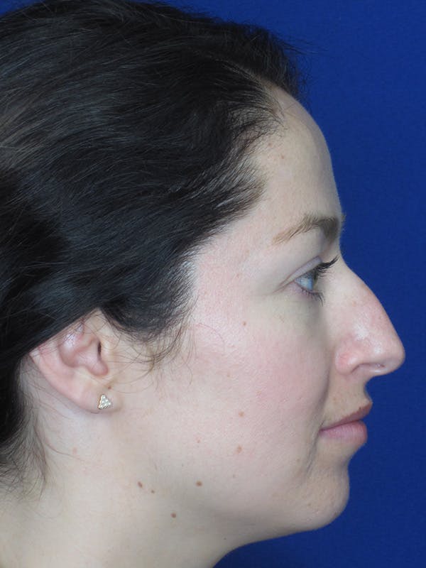 Rhinoplasty Before & After Gallery - Patient 165416659 - Image 1