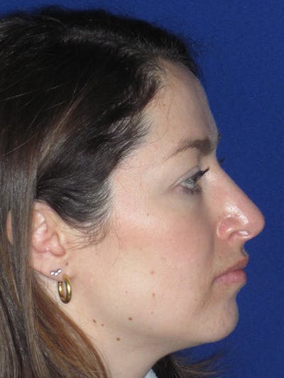 Rhinoplasty Before & After Gallery - Patient 165416659 - Image 2