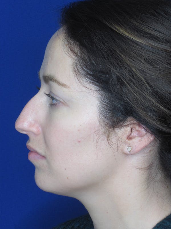 Rhinoplasty Before & After Gallery - Patient 165416659 - Image 7