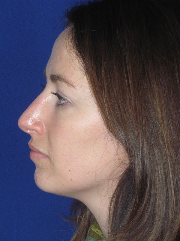 Rhinoplasty Before & After Gallery - Patient 165416659 - Image 8