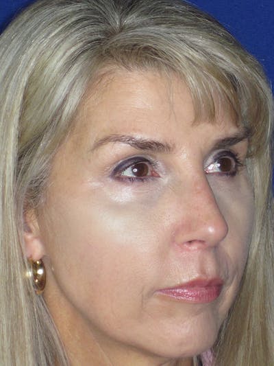 Rhinoplasty Before & After Gallery - Patient 165416660 - Image 4