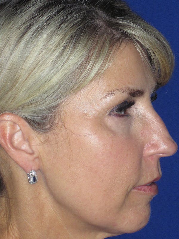 Rhinoplasty Before & After Gallery - Patient 165416660 - Image 5