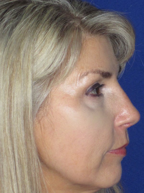 Rhinoplasty Before & After Gallery - Patient 165416660 - Image 6