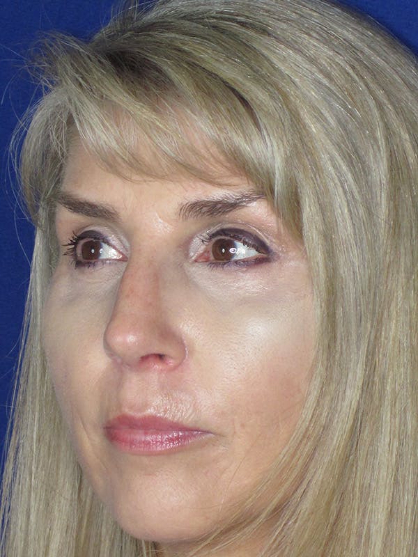 Rhinoplasty Before & After Gallery - Patient 165416660 - Image 8