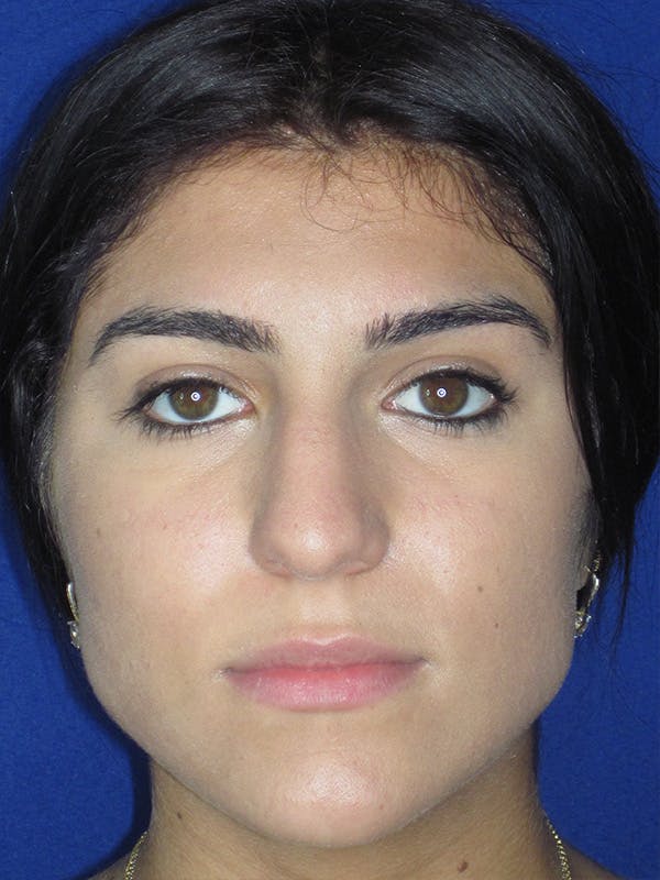 Rhinoplasty Before & After Gallery - Patient 165416661 - Image 7
