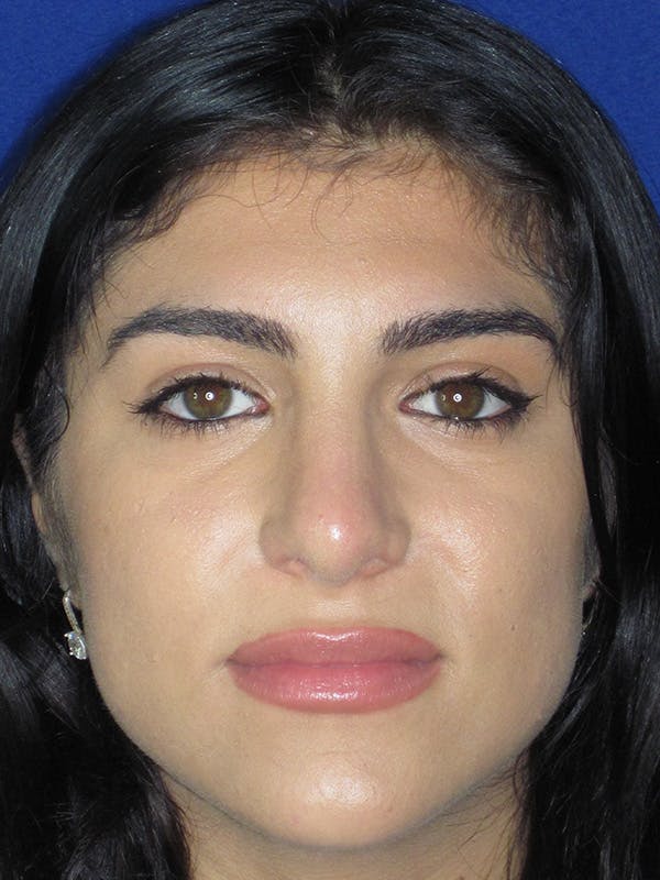 Rhinoplasty Before & After Gallery - Patient 165416661 - Image 8