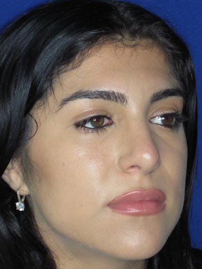 Rhinoplasty Before & After Gallery - Patient 165416661 - Image 4