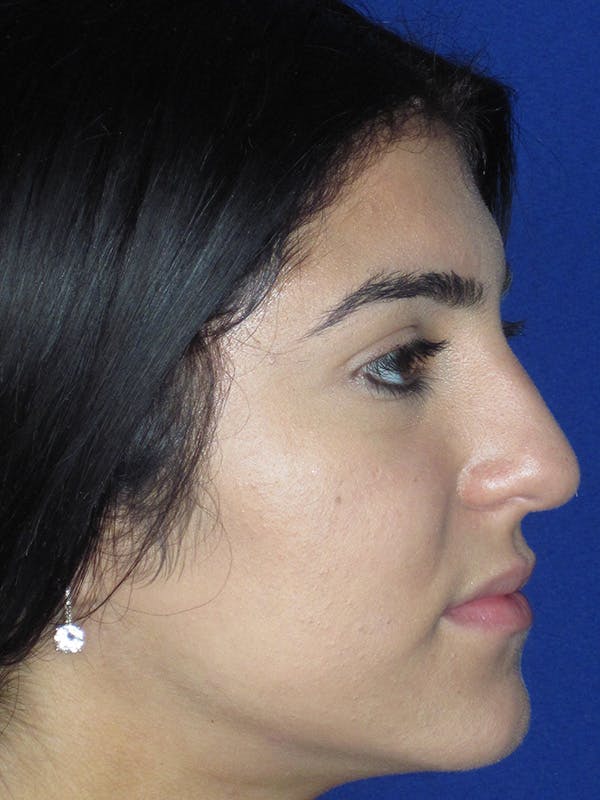 Rhinoplasty Before & After Gallery - Patient 165416661 - Image 1
