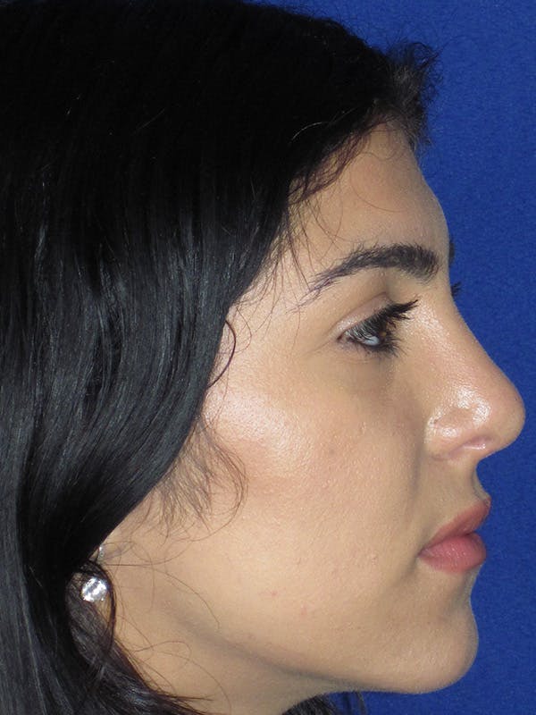 Rhinoplasty Before & After Gallery - Patient 165416661 - Image 2