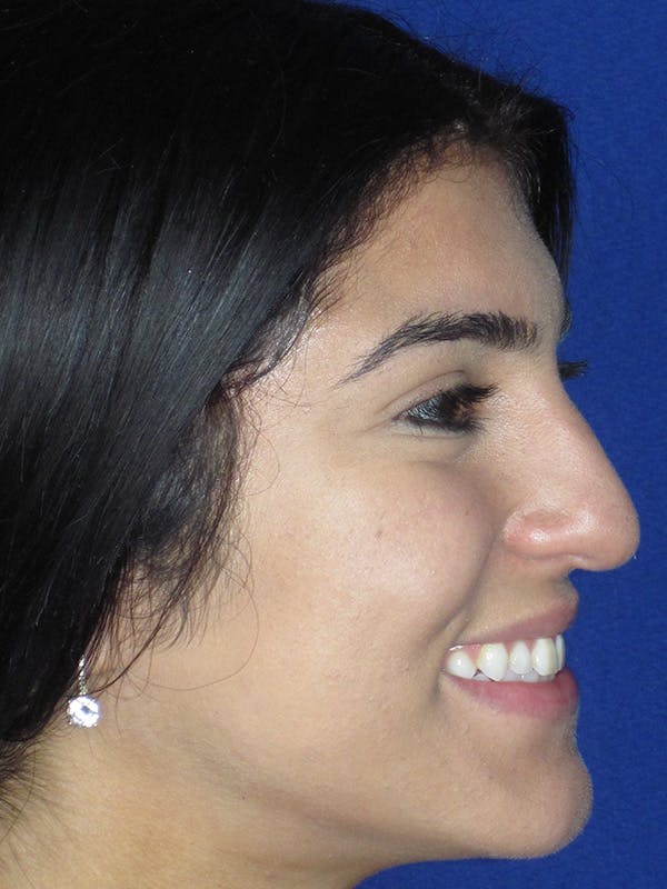 Rhinoplasty Before & After Gallery - Patient 165416661 - Image 5