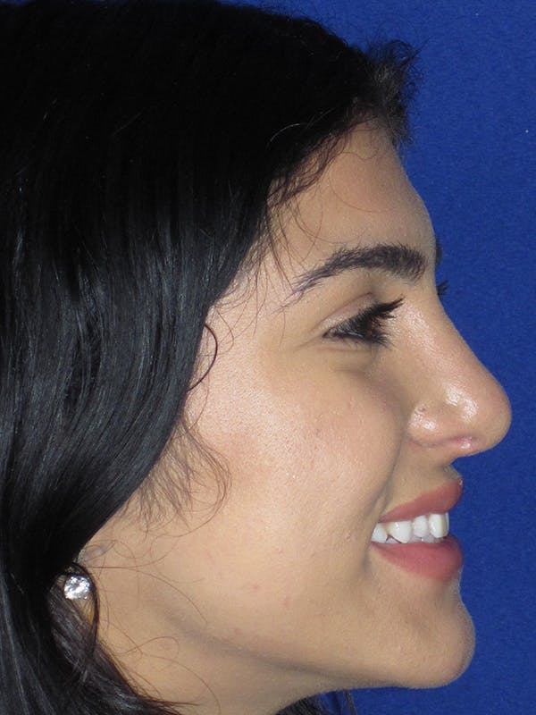 Rhinoplasty Before & After Gallery - Patient 165416661 - Image 6