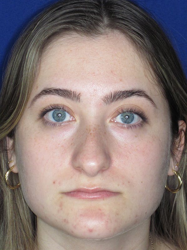 Rhinoplasty Before & After Gallery - Patient 165416662 - Image 3