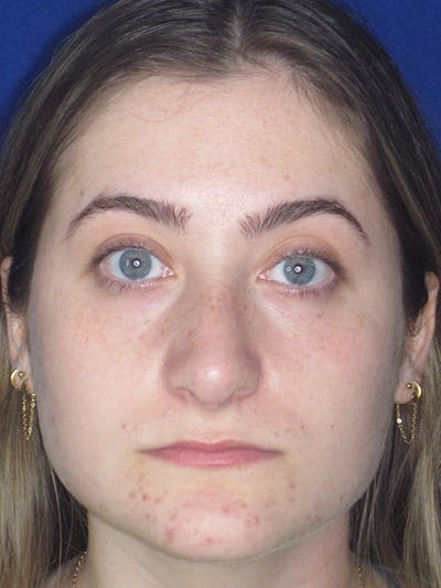 Rhinoplasty Before & After Gallery - Patient 165416662 - Image 4
